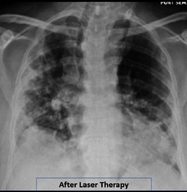 Research Covid19 - After MLS Laser treatment