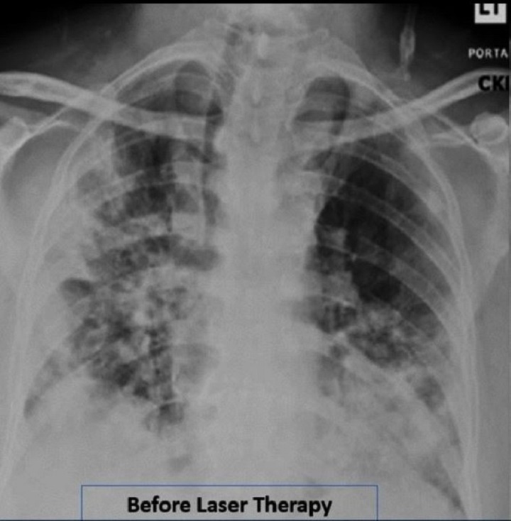 Research Covid19 - Before MLS Laser treatment