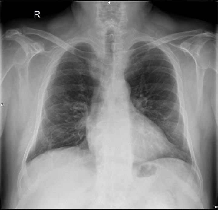 Chest X-rays after MLS
