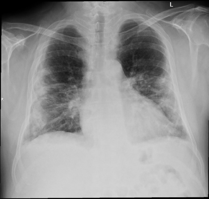 Chest X-rays before MLS