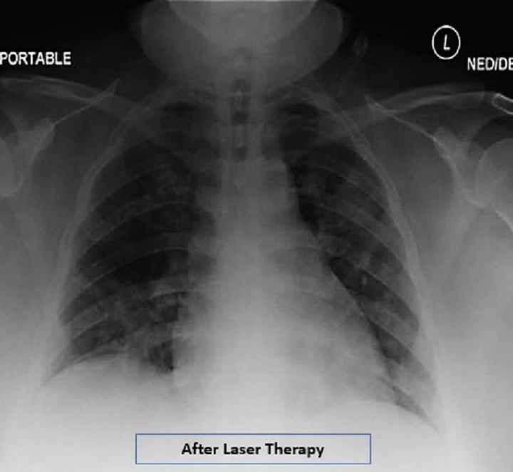 COVID19 case report - Radiographic assessment of lung edema - After MLS