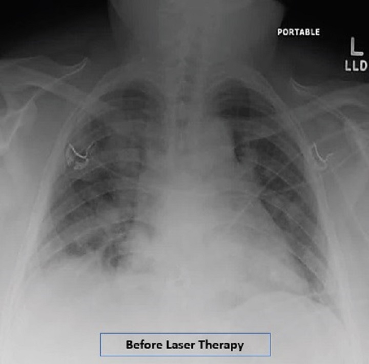 COVID19 case report - Radiographic assessment of lung edema - Before MLS