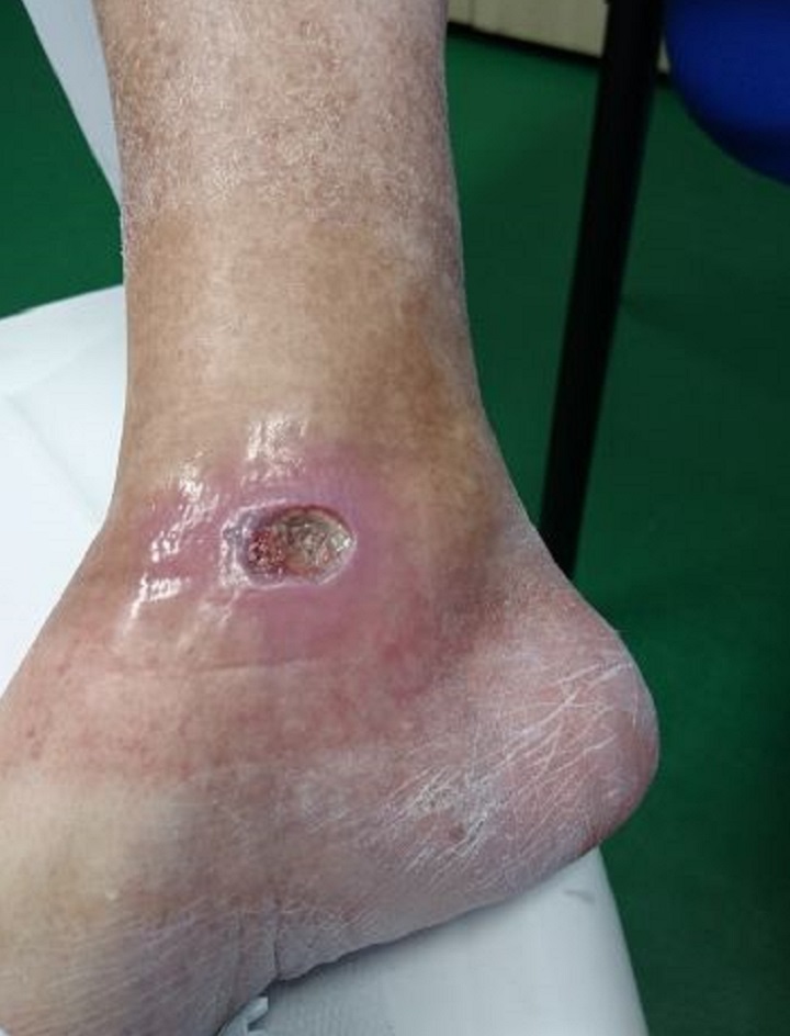 Diabetic foot ulcer - before MLS