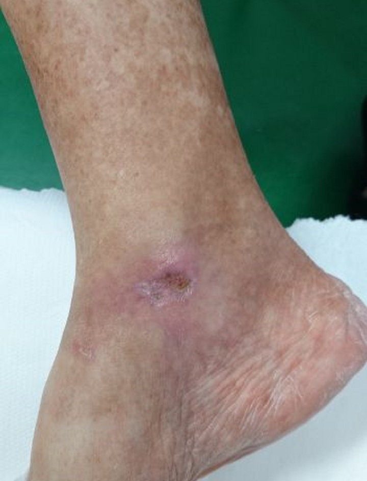 Diabetic foot ulcer - after MLS