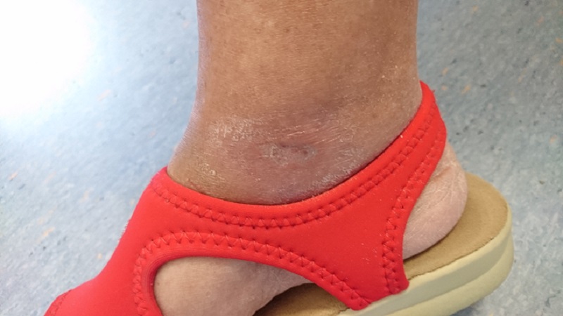 Diabetic foot ulcer - follow up