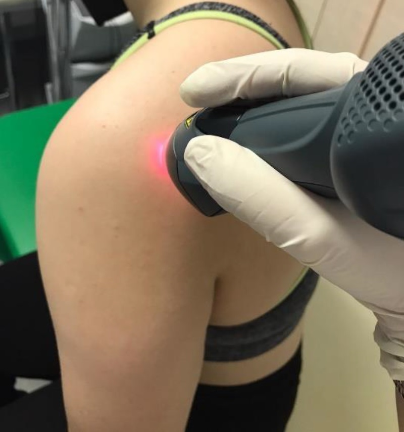 Mphi laser treatment for Subacromial Pain Syndrome