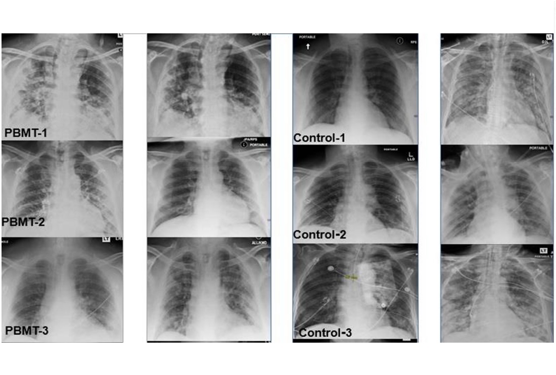 Chest X-rays before and after MLS