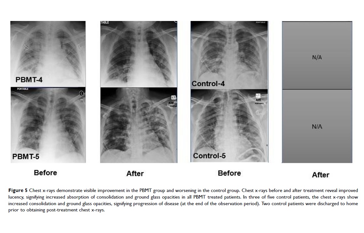 Chest X-rays 2 before and after MLS