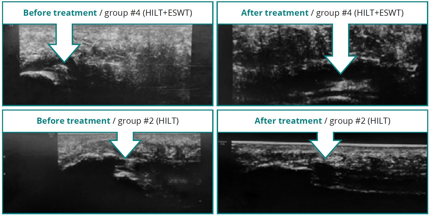 Ultrasound before after Hilterapia treatment
