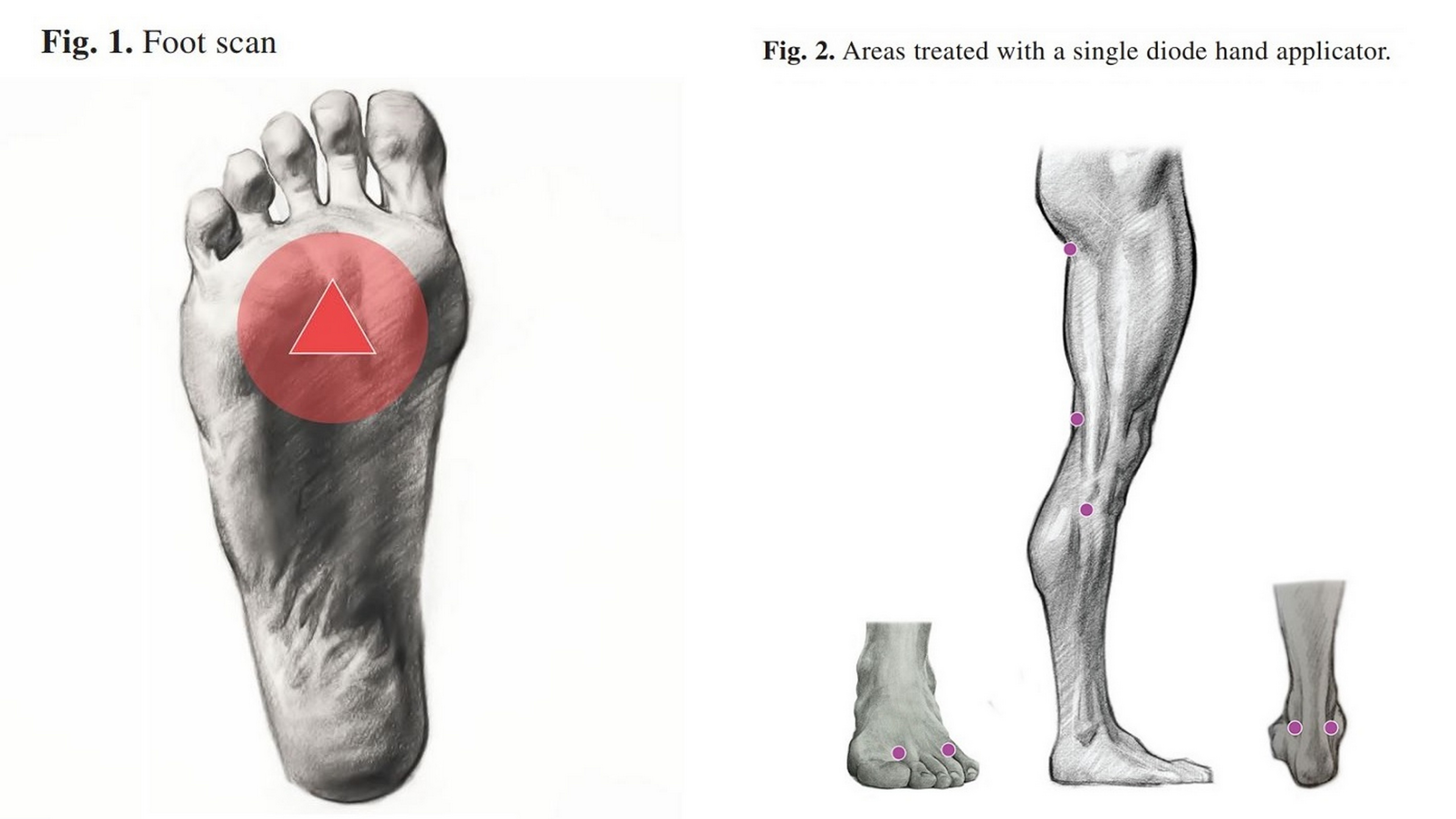 Scan and point-by-point MLS laser treatment - Neuropatic pain