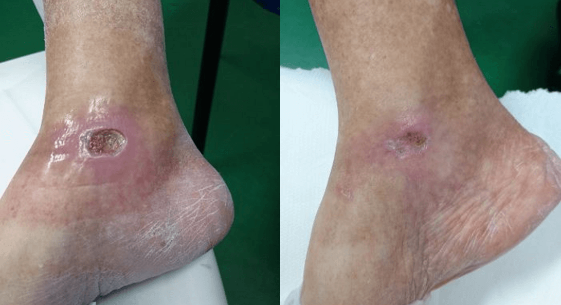 Ulcer wound healing with MiS laser device