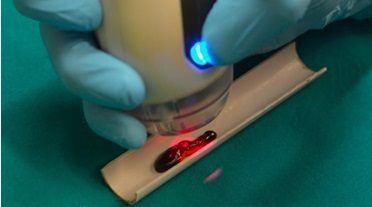 MiS laser-assisted wound care on a leech