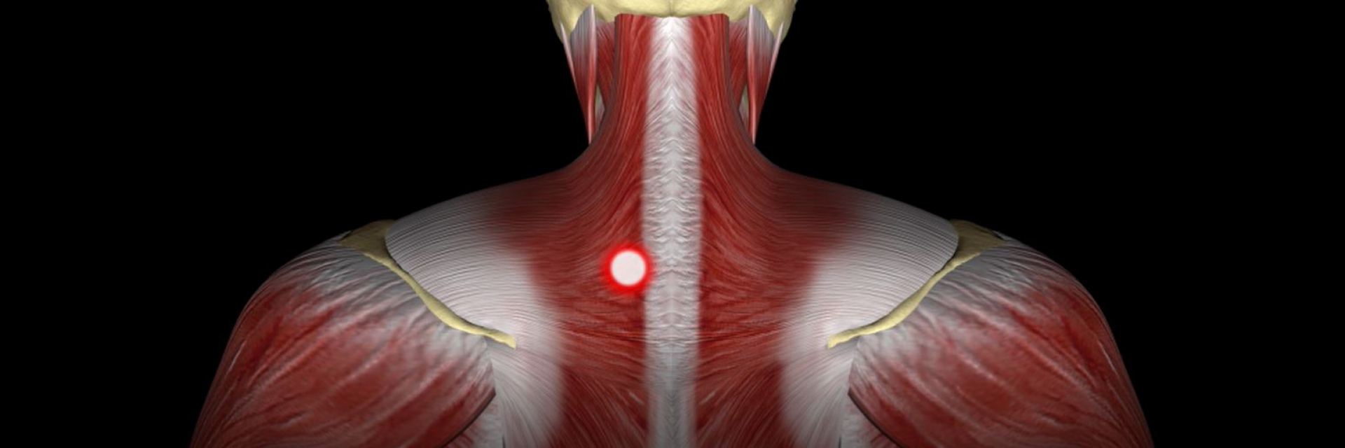 Trapezius muscle pain & trigger points