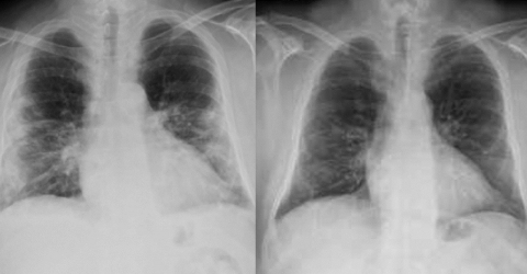 Before and After MLS Laser Therapy