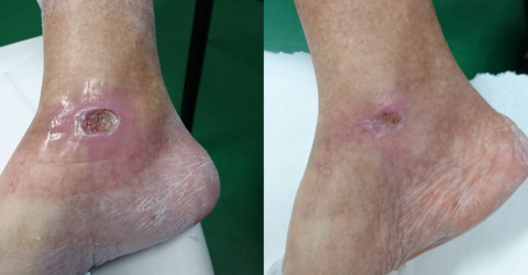 Before and After MLS Laser Therapy - Diabetic foot ulcer
