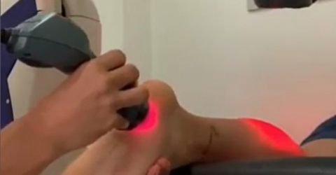 MLS laser treatment for footpain