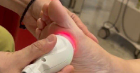  Diabetic Peripheral Neuropathic Pain Using MiS MLS Laser