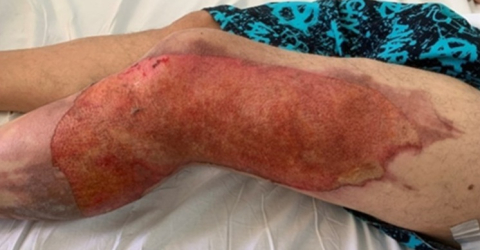 Post-burn lesion on the lateral surface of the lower limb