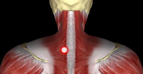 Hilterapia for myofascial pain syndrome