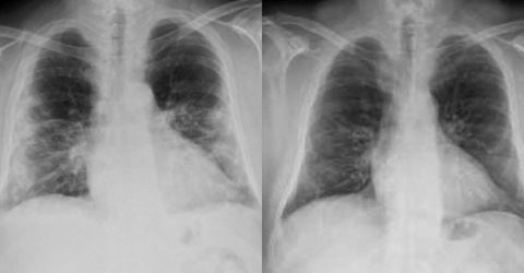 Before and after MLS - COVID19 laser treatment