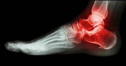 Research - painful calcaneal spur