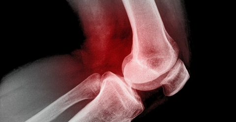 Knee pain - ASA research