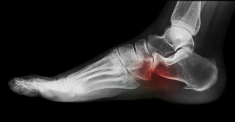 Research - Plantar Fasciitis